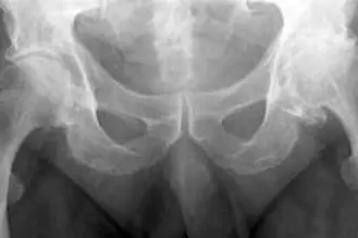 Røntgenbilde av hofte. Bilde.