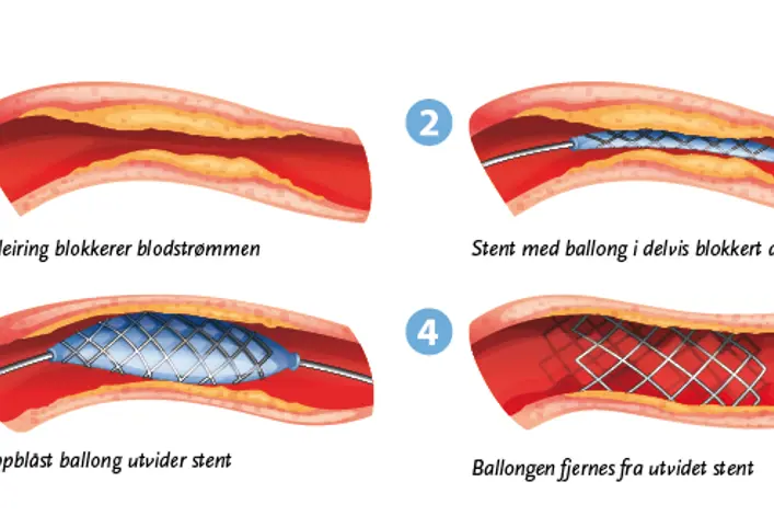 Fire ulike bilder illustrerer steg for steg hvordan invasiv kardiologi fungerer.